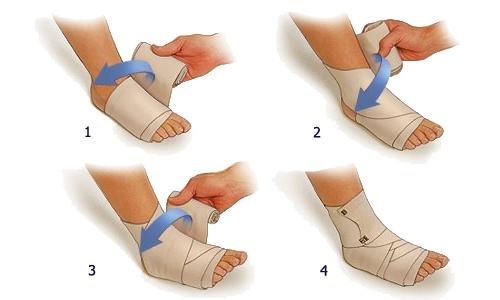 掌指关节扭伤处理方法,脚扭伤健康科普总结