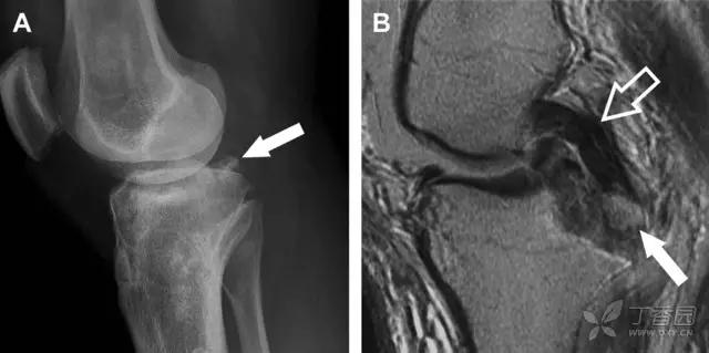 放射科夜班病例大全,放射科容易漏诊的骨折