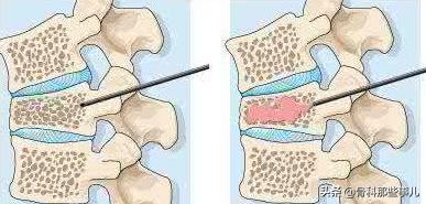 没有外伤怎么会肋骨骨折,没有外伤腰椎骨折是什么原因