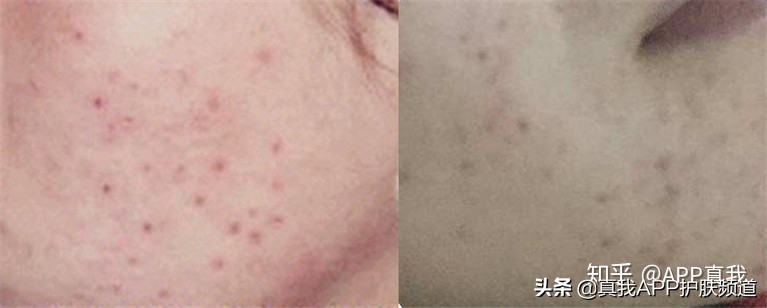 祛痘印效果最佳的产品是什么,祛痘印效果好的产品是什么