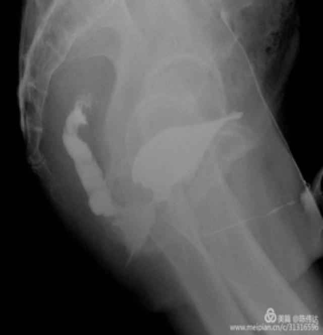 直肠尿道瘘轻的症状,尿道直肠瘘会死人吗