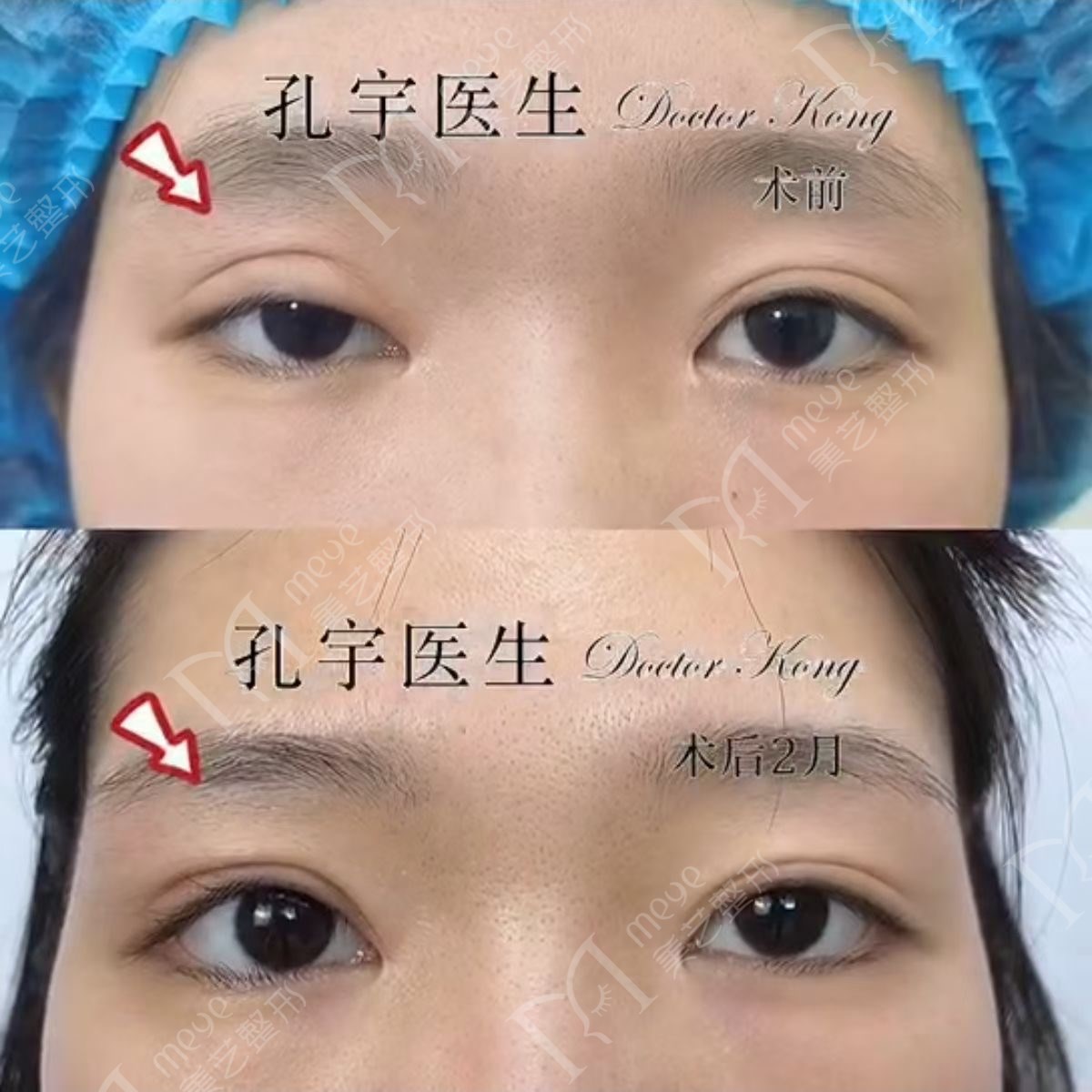 单眼上睑下垂修复术,上睑下垂眼睛修复手术成功率高吗