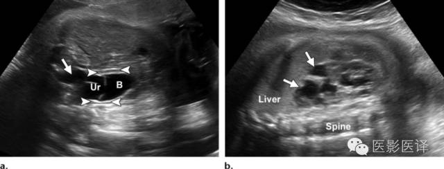 孕早期卵巢囊肿边界清形态规则,孕期卵巢囊肿呈液性伴点状回声
