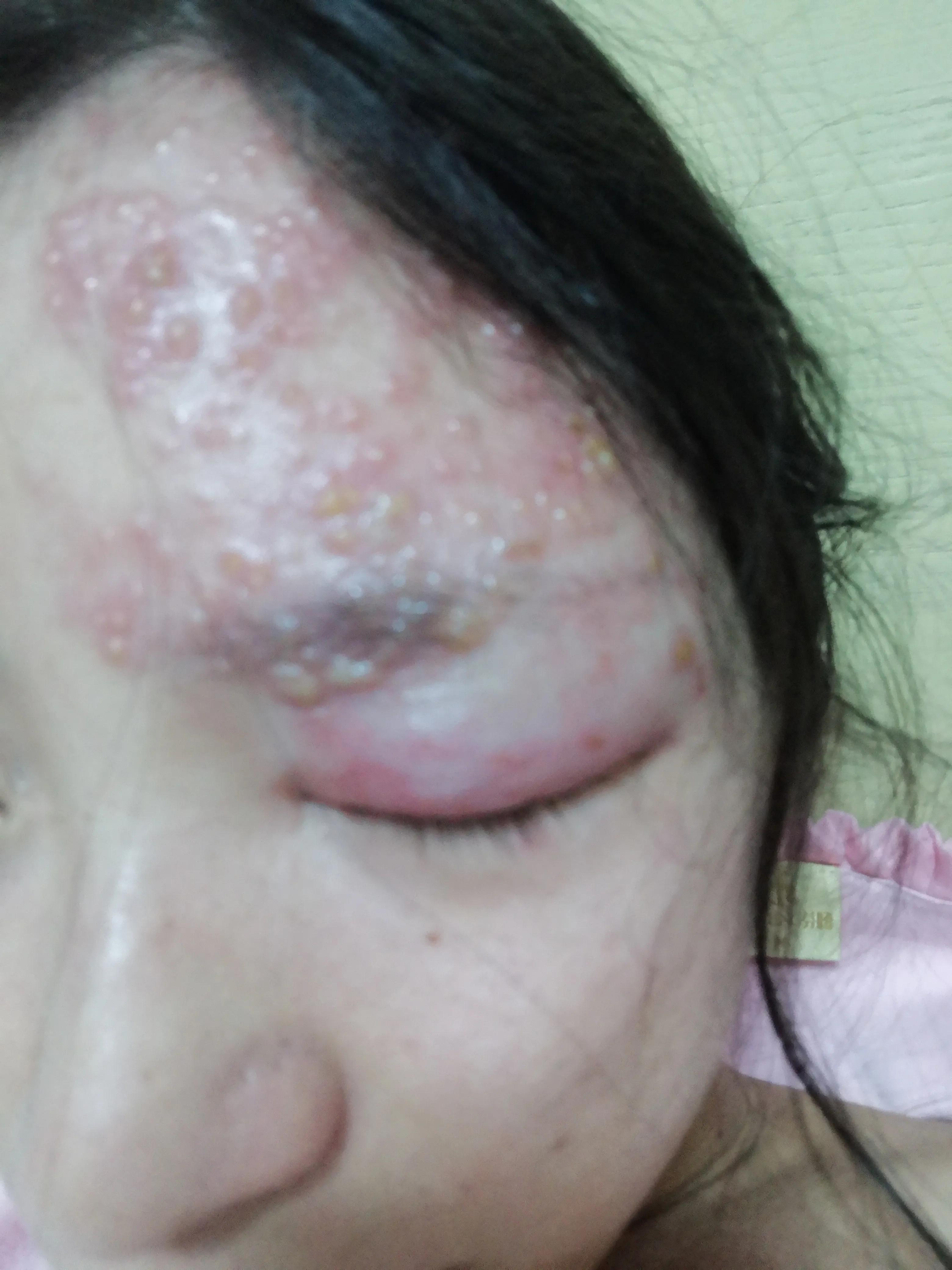 孕妇得了带状疱疹病毒怎么办,孕中期得带状疱疹该怎么办