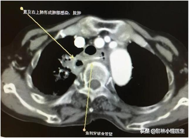 误吞假牙吃什么有助于排出,误吞假牙怎么处理