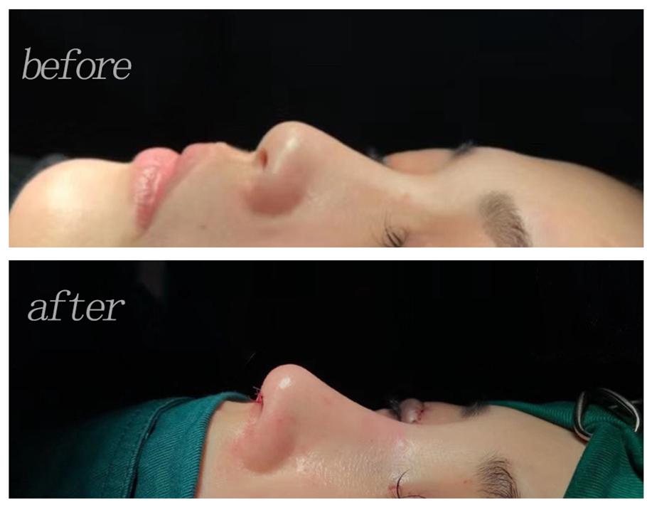 男生隆鼻很假,软骨隆鼻假吗