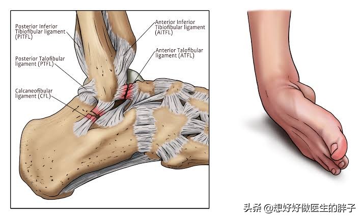 腓骨远端损伤后，如恢复特别慢，有哪些常见原因，又该如何应对呢