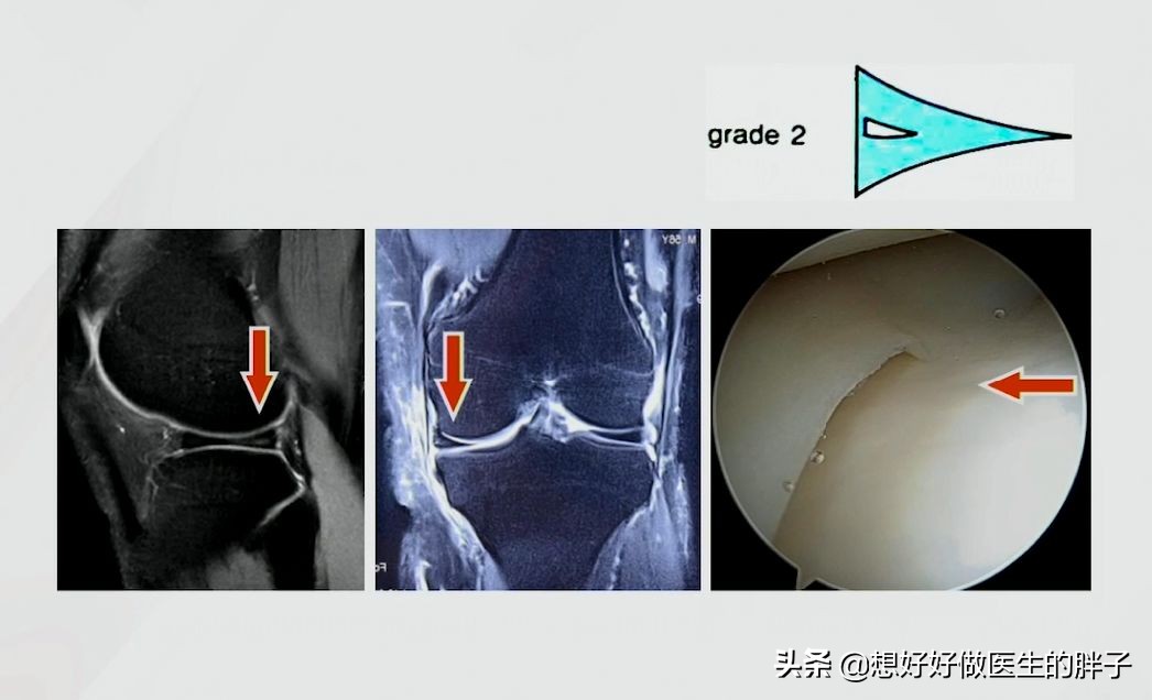 为什么足球运动员不会半月板受伤,足球运动半月板损伤
