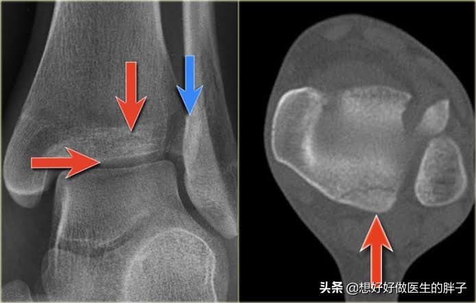 腓骨远端损伤后，如恢复特别慢，有哪些常见原因，又该如何应对呢
