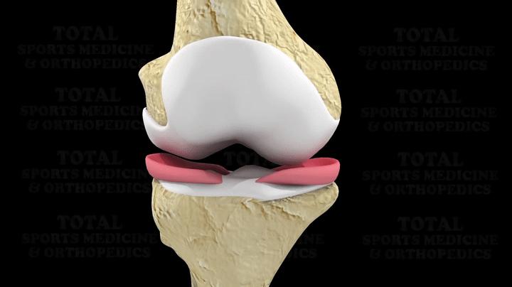 半月板缝合术后膝盖肿胀怎么消除,半月板缝合术后肿胀正常吗