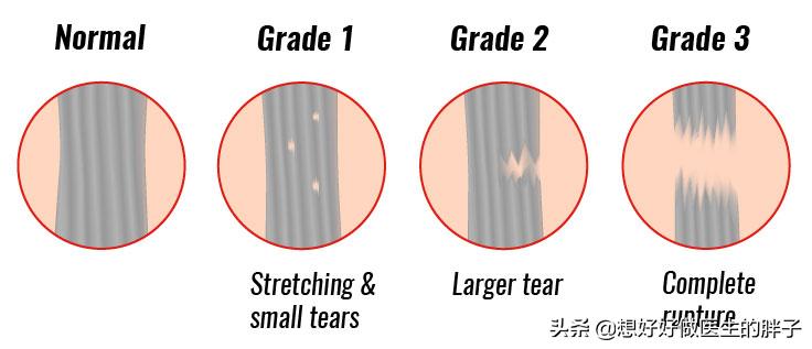 什么是肌腱损伤,怎么判断是韧带损伤还是肌腱炎