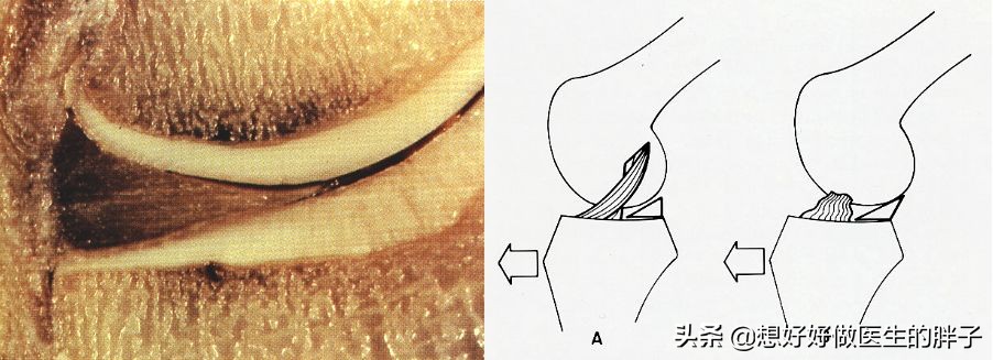 足球运动员有半月板问题吗,足球运动员为什么没有半月板