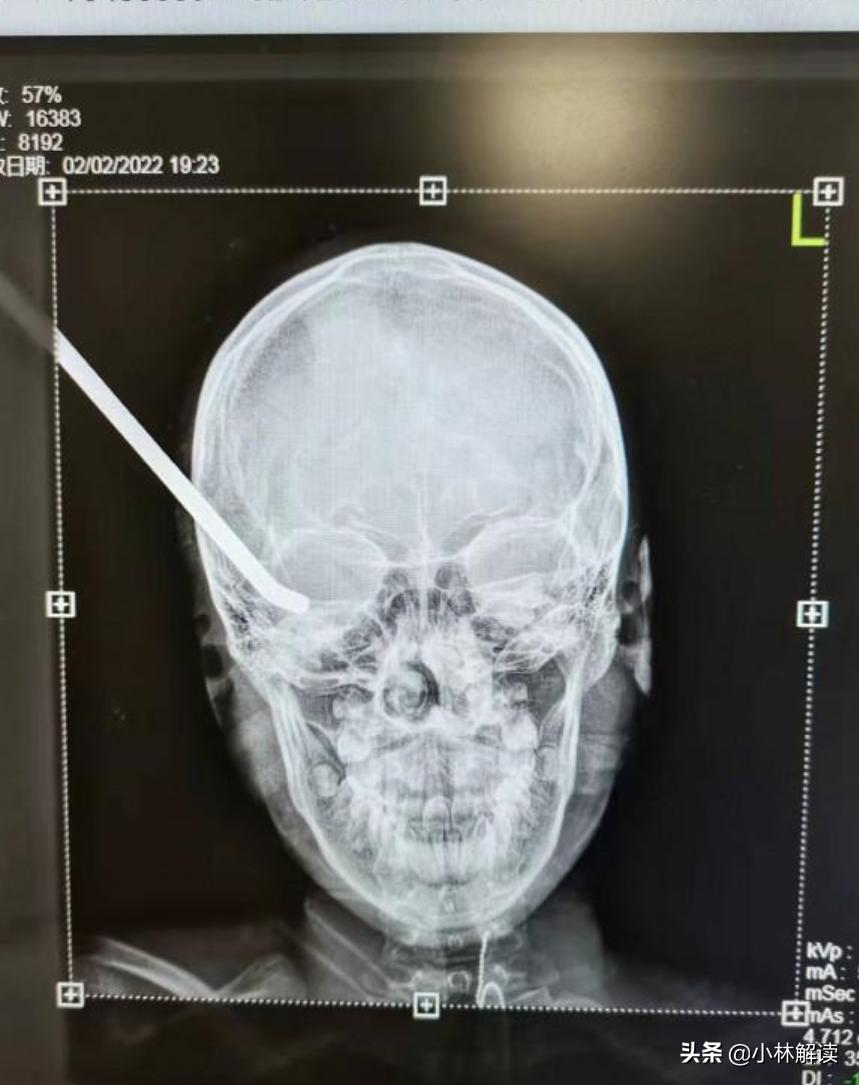 孩子被木棍插入脑中抢救无效死亡,小女孩逛商场摔倒被铁棍刺入大脑