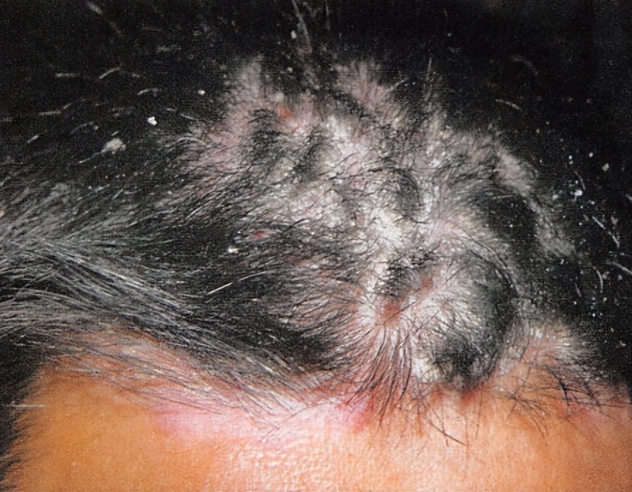 头皮有很多红疙瘩是脂溢性皮炎吗,脂溢性皮炎头皮是由什么引起的