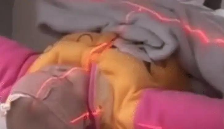 连体婴姐妹18年成功分离,连体婴姐妹成功分离后续