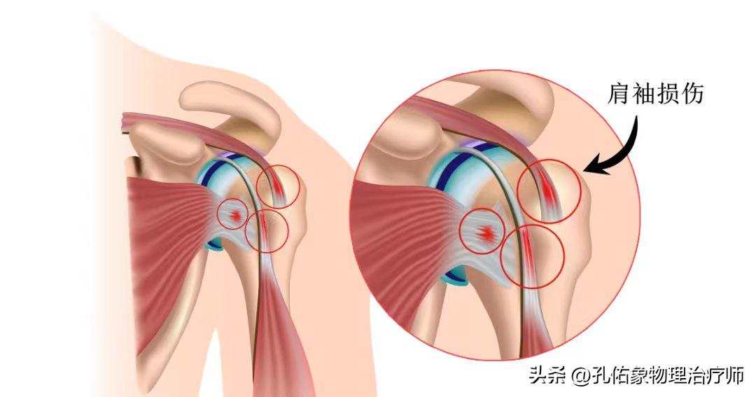 左边肩膀疼痛的治疗方法小妙招,肩膀手往后抬时疼痛是什么原因