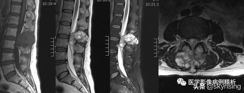 脊索瘤造成骨质破坏严重吗,多发椎体骨质破坏考虑转移瘤
