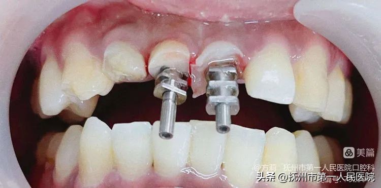 种植牙可修复多种牙齿缺失类型,学科建设口腔科