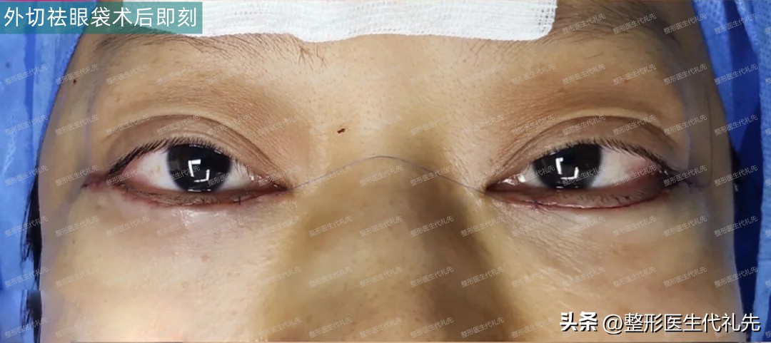眼袋手术52天,眼袋手术27天了还用抹祛疤膏吗