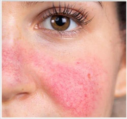 点阵激光和光子嫩肤哪个副作用小,光子嫩肤是什么作用和功效呢