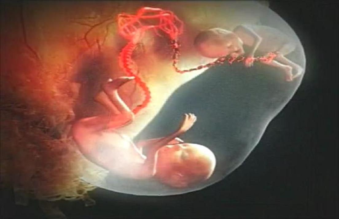 印度女子产下罕见胎中胎,胎中胎真实案例印度