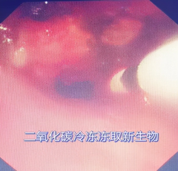 哈医大一院气管镜,哈医大群力呼吸内科