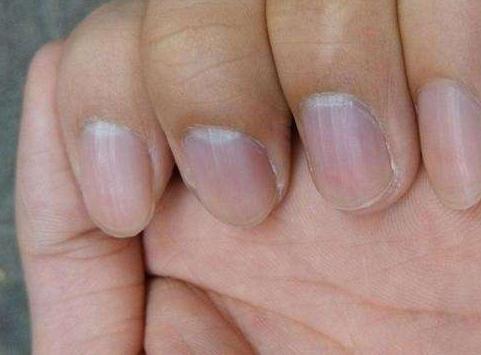 一招教你解决贫血,一招检查自己贫血