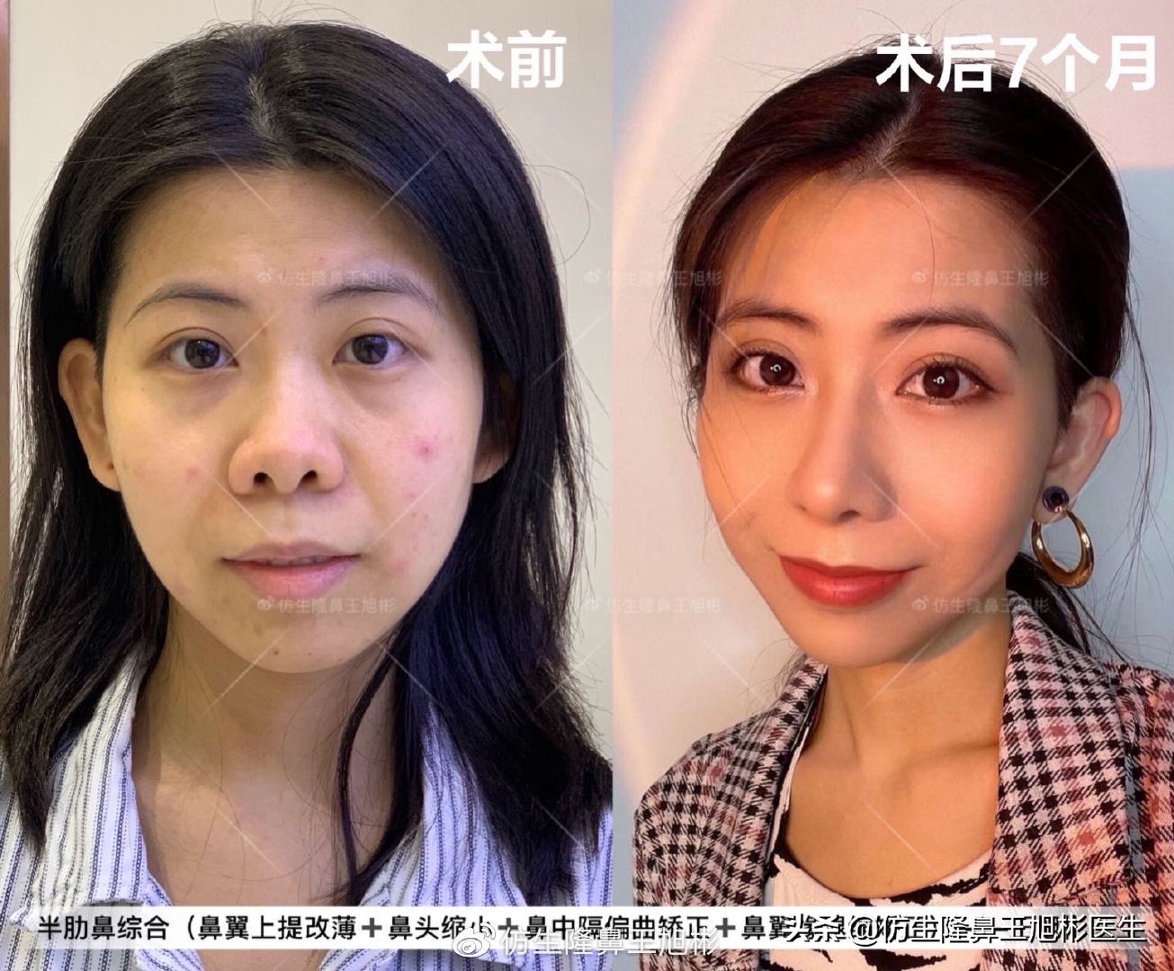 常见鼻部整形美容项目,整形鼻和自然鼻