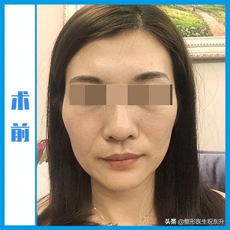 拉皮手术面诊,华西拉皮手术面诊后多长时间手术