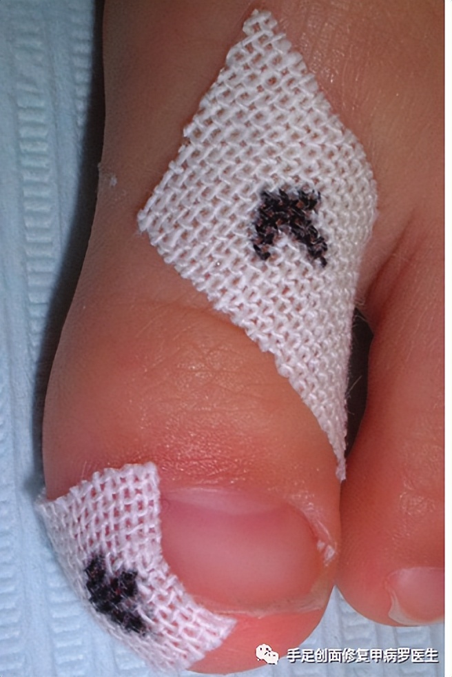 宝宝脚趾甲有脓了怎么处理,给宝宝剪指甲流脓怎么办