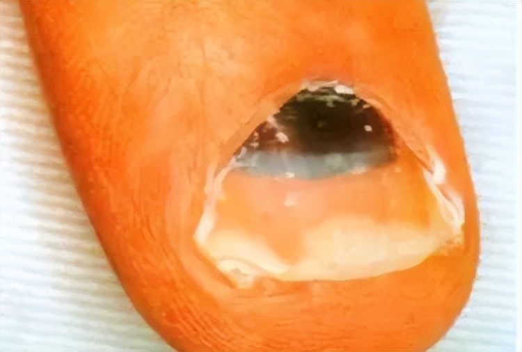 指甲上有黑线的预兆,指甲上有小黑线要注意哪些