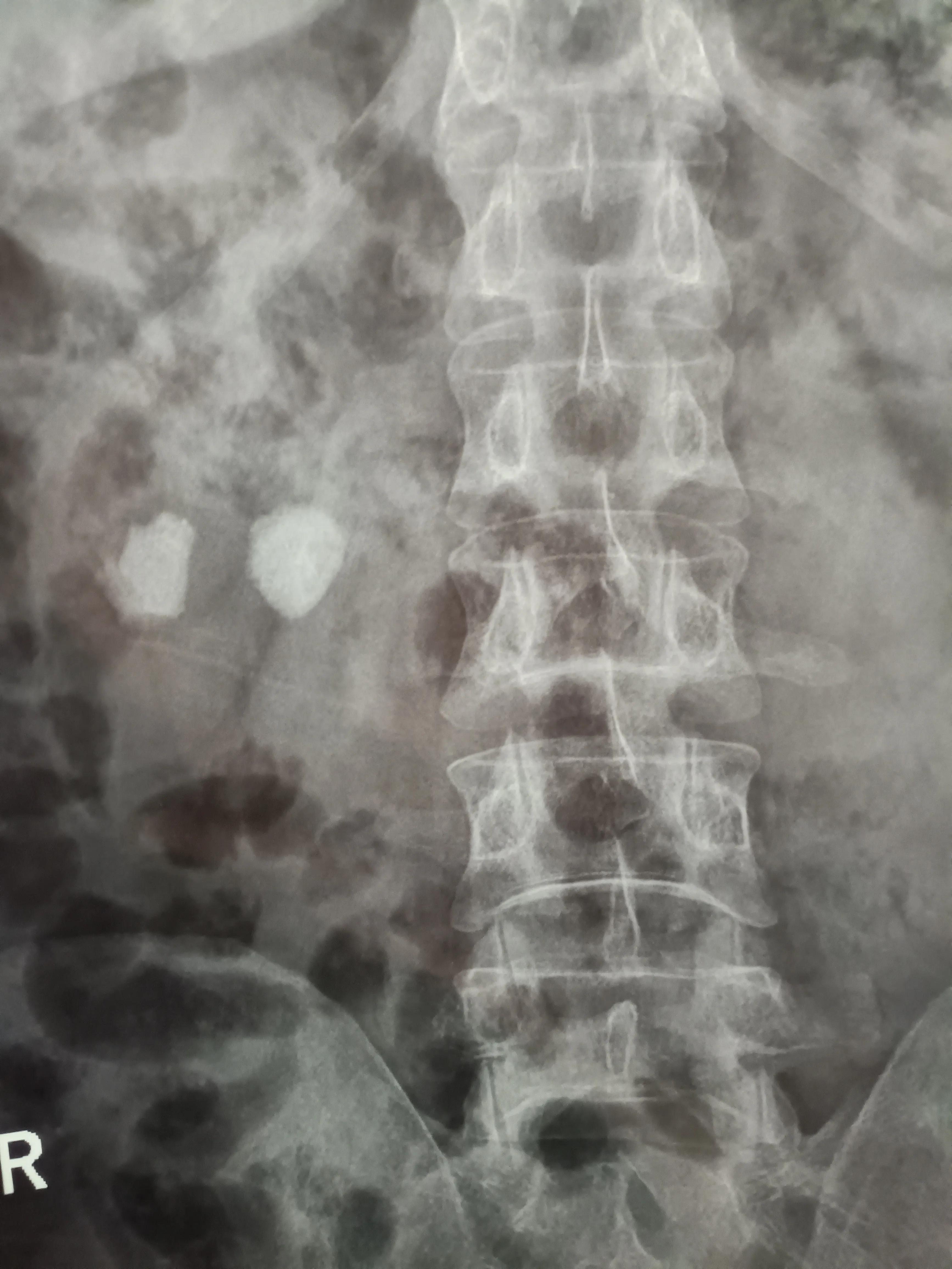 肾结石经皮肾镜两次手术间隔多久,两公分的肾结石需要动几次手术