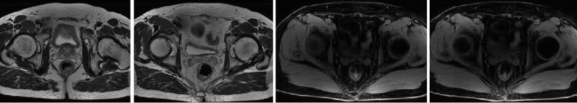 中国国内结直肠癌最新治疗,结直肠癌治好的可能性大吗