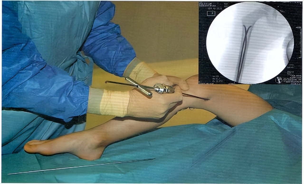 儿童股骨干粉碎性骨折对位不太好,儿童股骨干骨折石膏固定