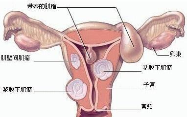 女性冷知识子宫肌瘤,子宫肌瘤克星一览表