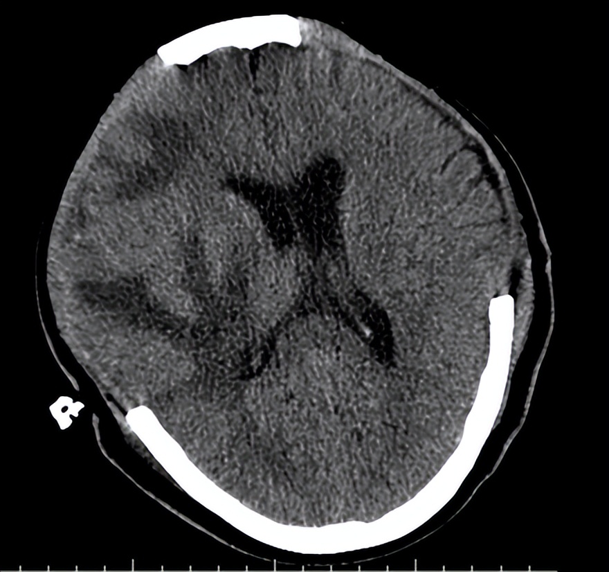 医院成功救治重型颅脑患者,特重型颅脑损伤治愈案