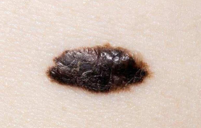 身上这3个地方长痣癌症可能来了,身上三个地方出现痣说明是癌变