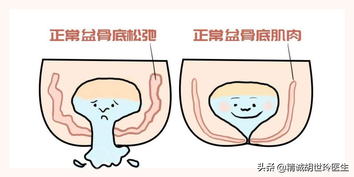 盆底肌无力与子宫脱垂能正常怀孕吗？