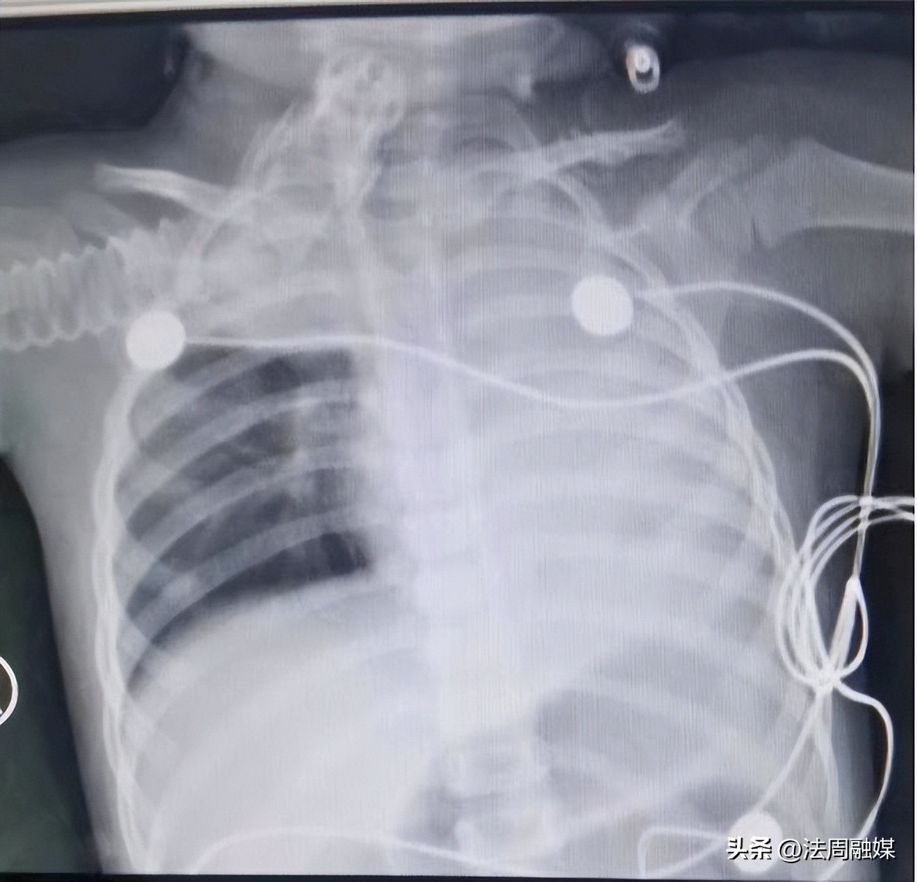 孩子坚果卡喉致死,婴幼儿吃坚果卡喉咙案例