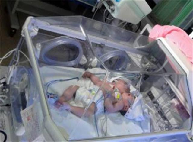 中国首例双头婴儿现状如何,全国首例双头婴儿现在咋样了