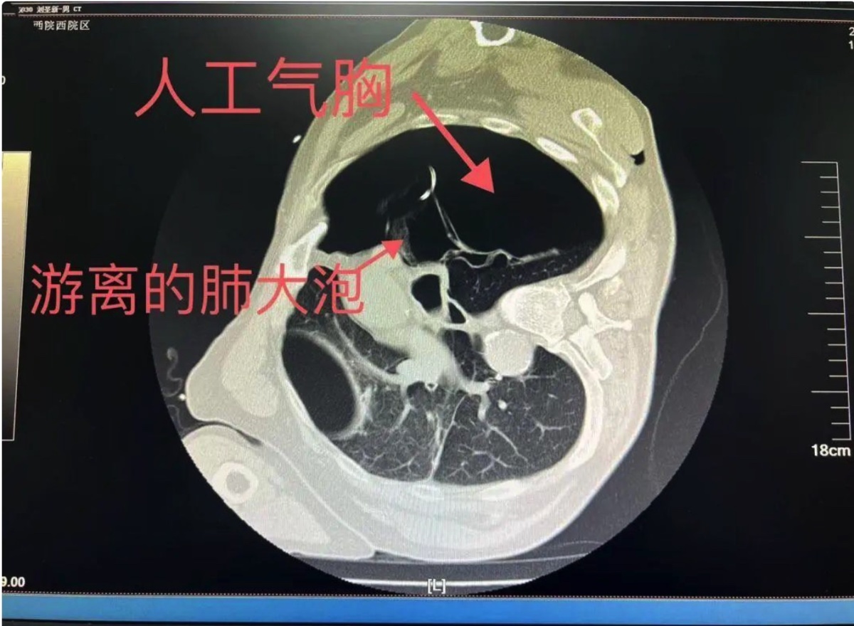 慢阻肺末期双肺移植,慢阻肺肺大泡手术有危险吗