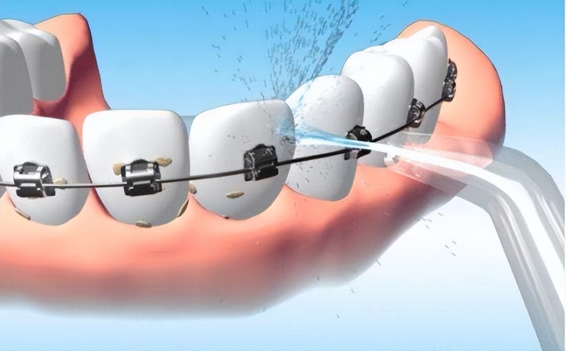 拜尔冲牙器评测推荐,冲牙器平价测评推荐