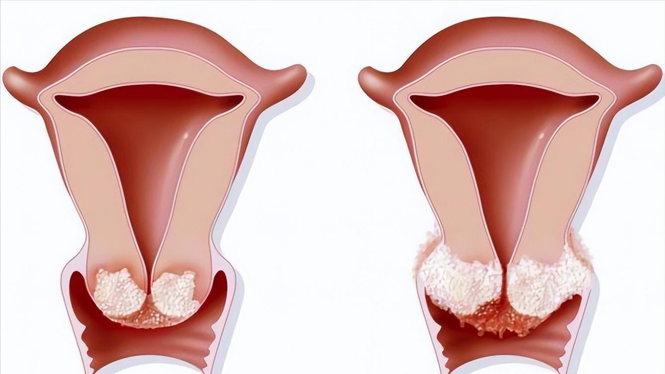 感染了hpv一定会得宫颈癌吗,宫颈癌早期10种症状做hpv多少钱