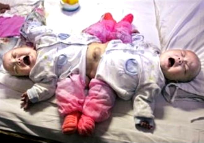 中国首例坐骨连体婴,坐骨连体姐妹分离成功了吗