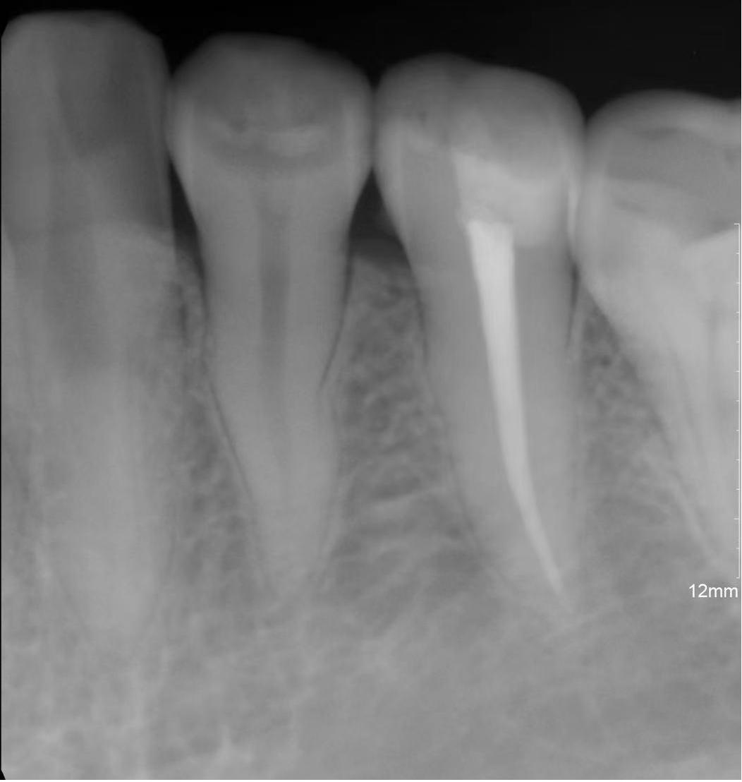 口腔牙龈内壁长硬包是上火吗,牙龈肿痛上火有个脓包怎么办