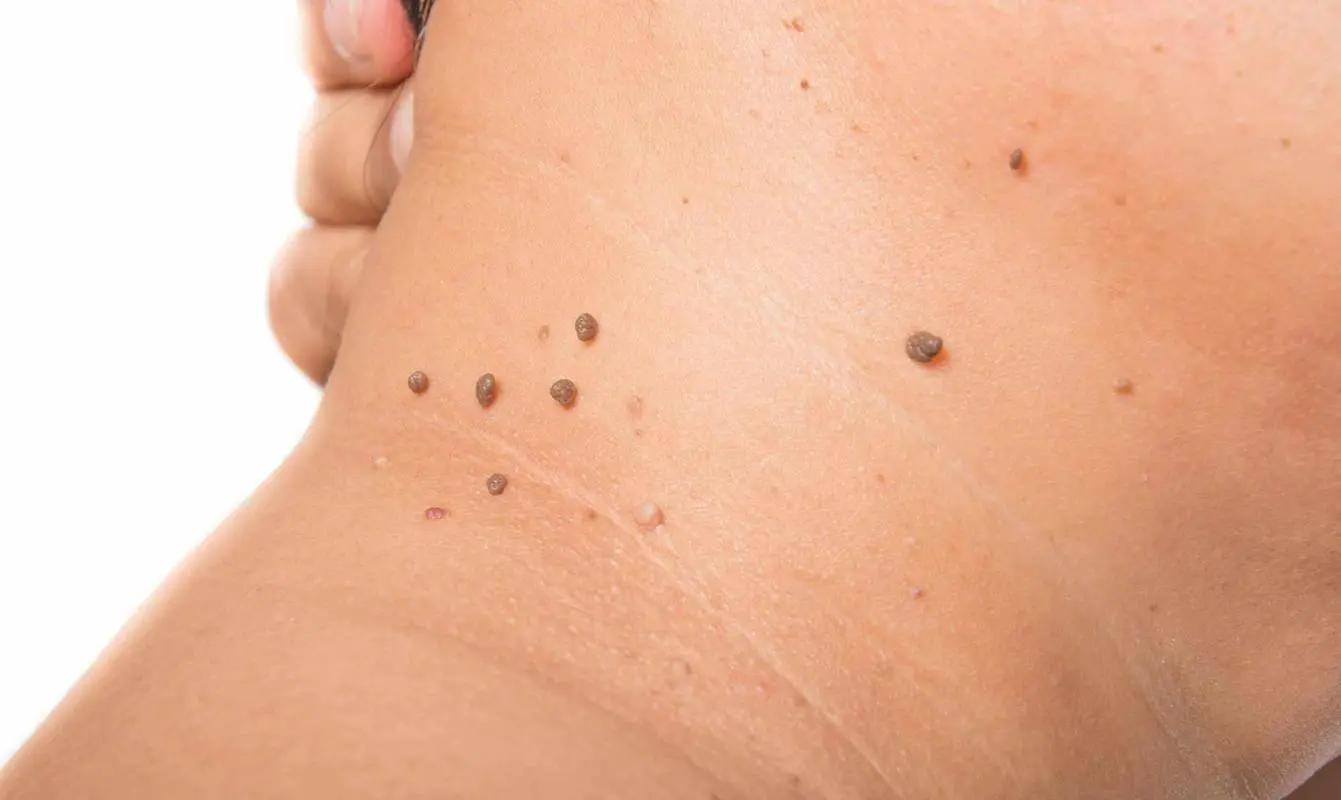 脖子和腋下的小肉粒是什么,脖子和腋下长小肉刺会自己脱落吗