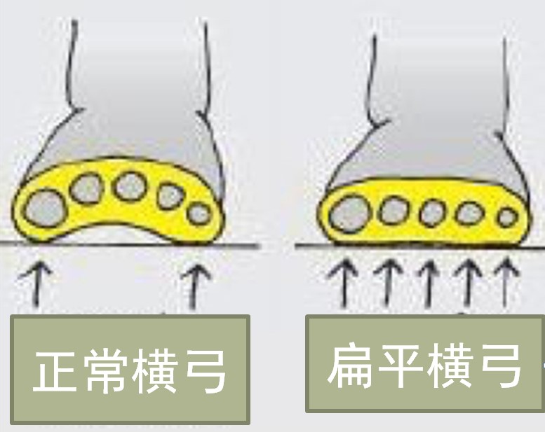 小孩子多大需要干预扁平足,8岁女孩扁平足需要干预吗