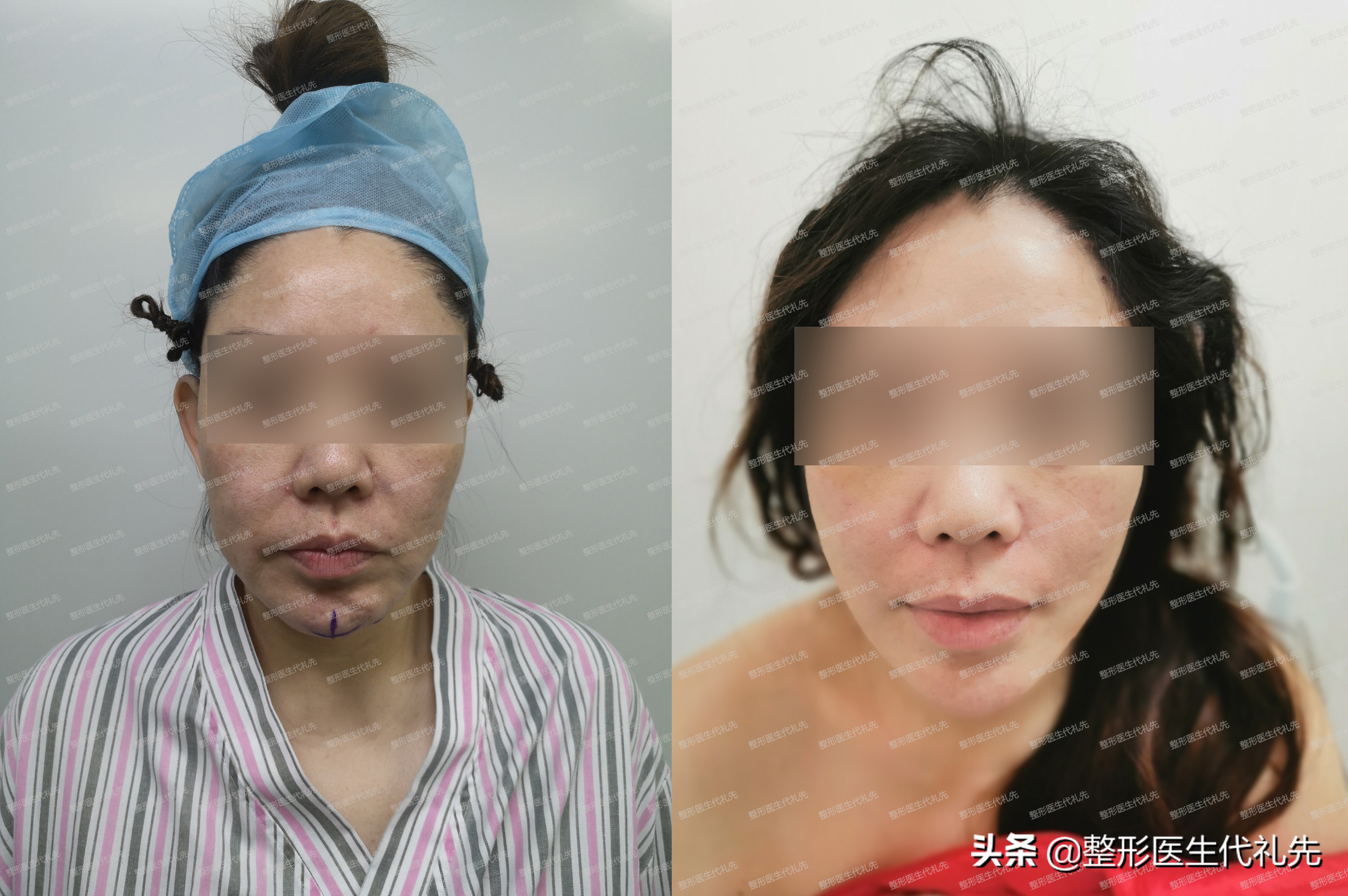 一秒消除法令纹,一次性治愈法令纹