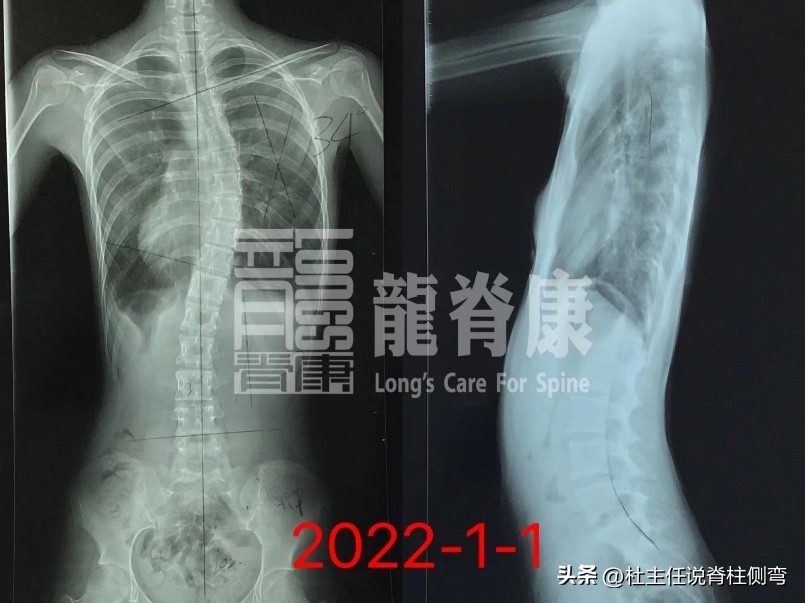 43岁女孩确诊脊柱侧弯症,中学14岁女生患脊柱侧弯20度