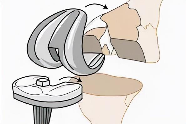 膝盖疼痛的自我康复训练方法,三个日常小习惯保护膝盖缓解膝痛